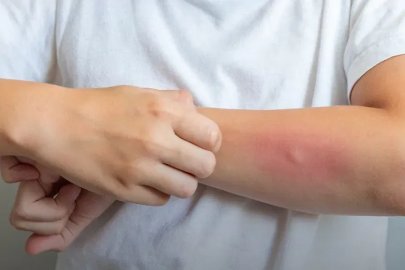 Egzama yalnızca cildi değil, sosyal yaşamı da etkileyebiliyor